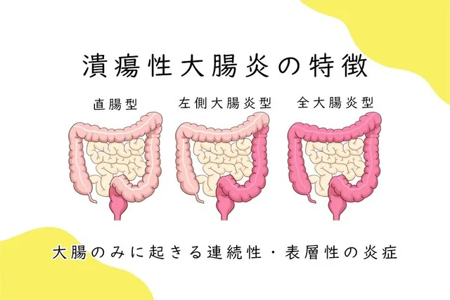 潰瘍性大腸炎の特徴