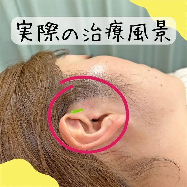 突発性難聴の治療風景
