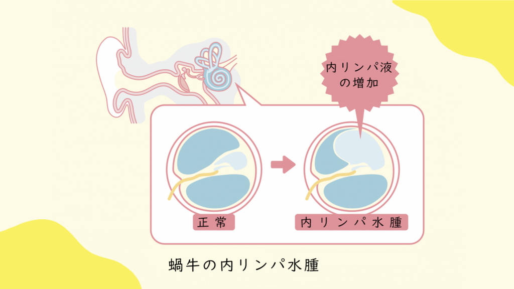 メニエール病　ブログ画像２