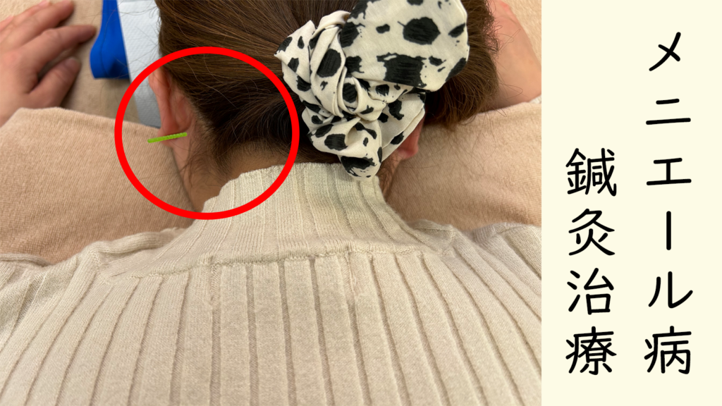 メニエール病　ブログ画像４