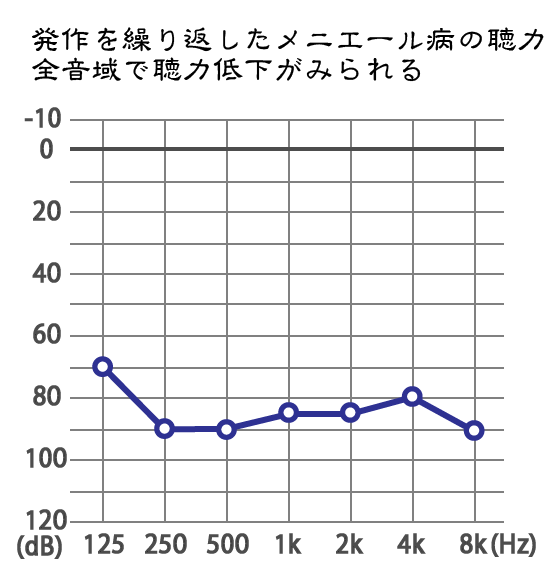 メニエール病：難聴の聴力水平型